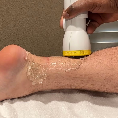 softwave-shockwave-therapy-ankle-preferred-therapy-services-highland-ca